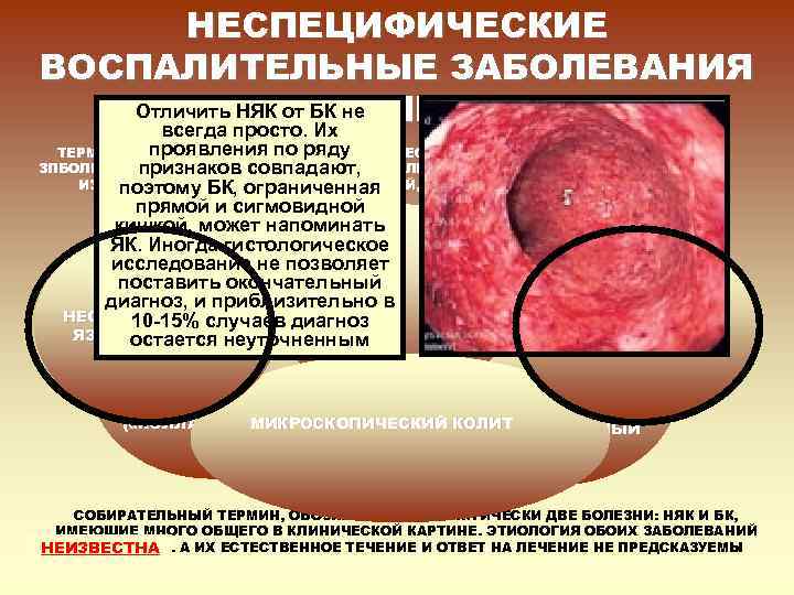   НЕСПЕЦИФИЧЕСКИЕ ВОСПАЛИТЕЛЬНЫЕ ЗАБОЛЕВАНИЯ    КИШЕЧНИКА  Отличить НЯК от БК