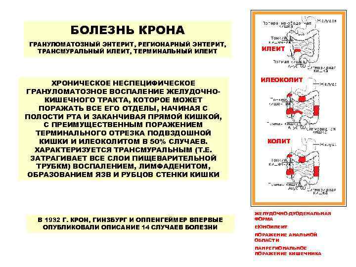    БОЛЕЗНЬ КРОНА ГРАНУЛОМАТОЗНЫЙ ЭНТЕРИТ, РЕГИОНАРНЫЙ ЭНТЕРИТ,  ТРАНСМУРАЛЬНЫЙ ИЛЕИТ, ТЕРМИНАЛЬНЫЙ ИЛЕИТ