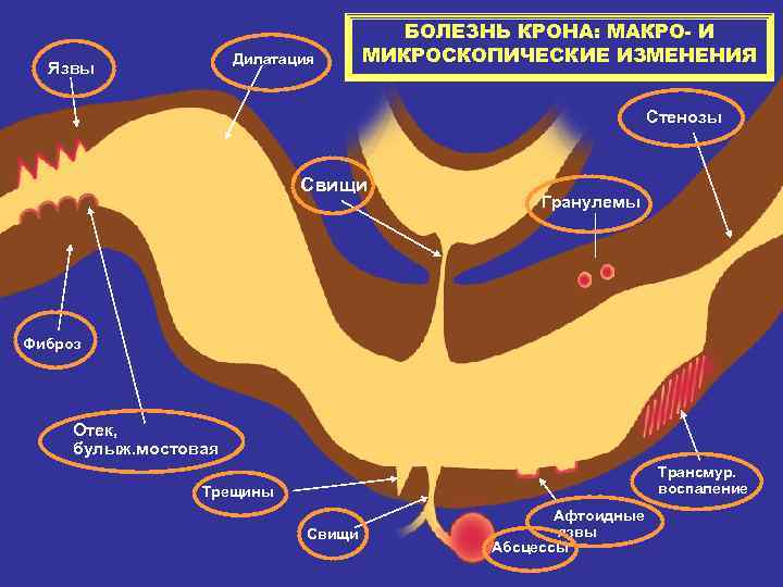        БОЛЕЗНЬ КРОНА: МАКРО- И   