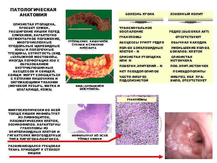  ПАТОЛОГИЧЕСКАЯ АНАТОМИЯ    БОЛЕЗНЬ КРОНА  ЯЗВЕННЫЙ КОЛИТ СЛИЗИСТАЯ УТОЛЩЕНА, 