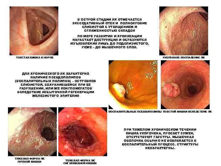      В ОСТРОЙ СТАДИИ ЯК ОТМЕЧАЕТСЯ    