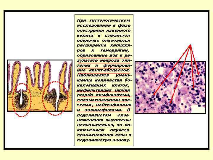   При гистологическом исследовании в фазе обострения язвенного колита в слизистой оболочке отмечаются
