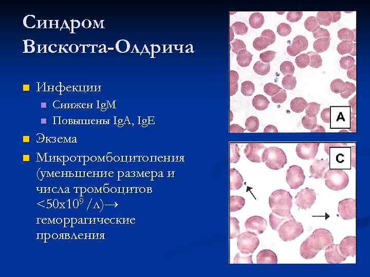 Синдром Вискотта-Олдрича n  Инфекции n  Снижен Ig. M n  Повышены Ig.