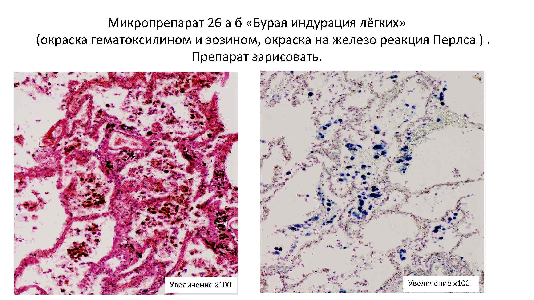 Гемосидероз легкого микропрепарат
