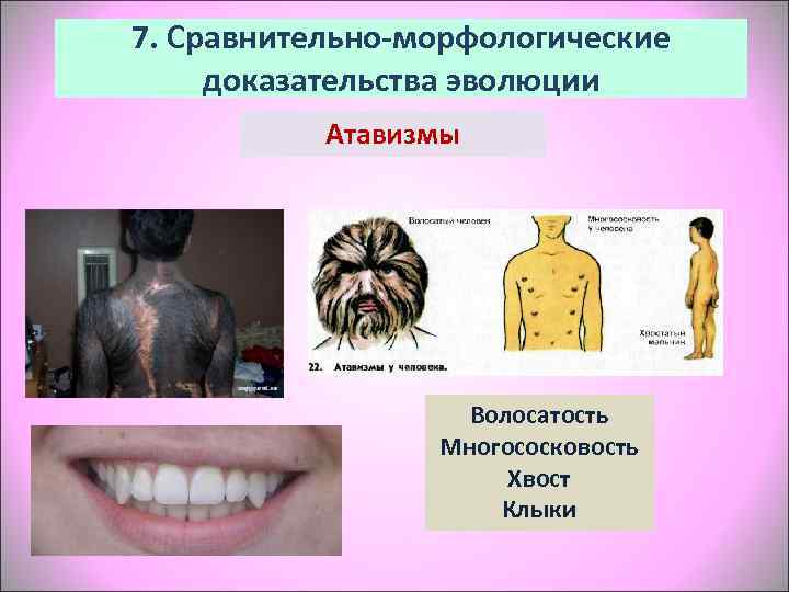 7. Сравнительно-морфологические доказательства эволюции  Атавизмы     Волосатость   