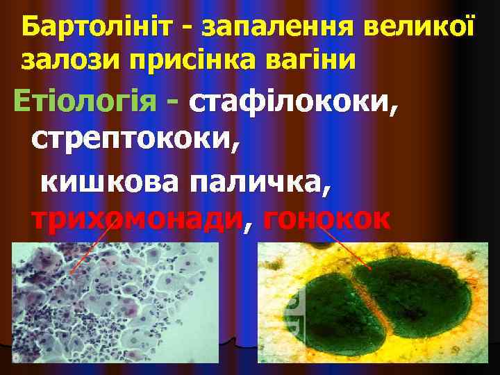 Бартолініт - запалення великої залози присінка вагіни Етіологія - стафілококи,  стрептококи,  кишкова