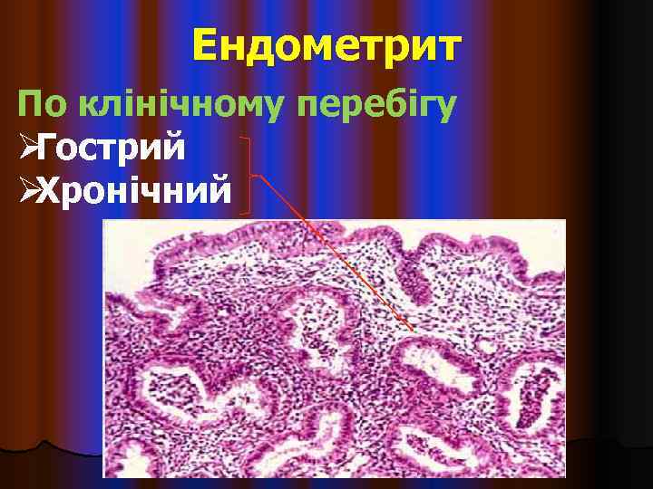   Ендометрит По клінічному перебігу ØГострий ØХронічний 