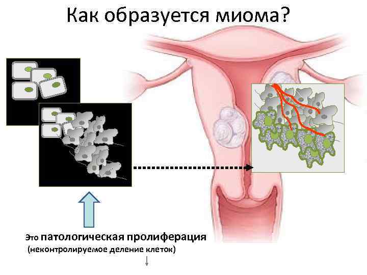   Как образуется миома? Это патологическая пролиферация (неконтролируемое деление клеток) 