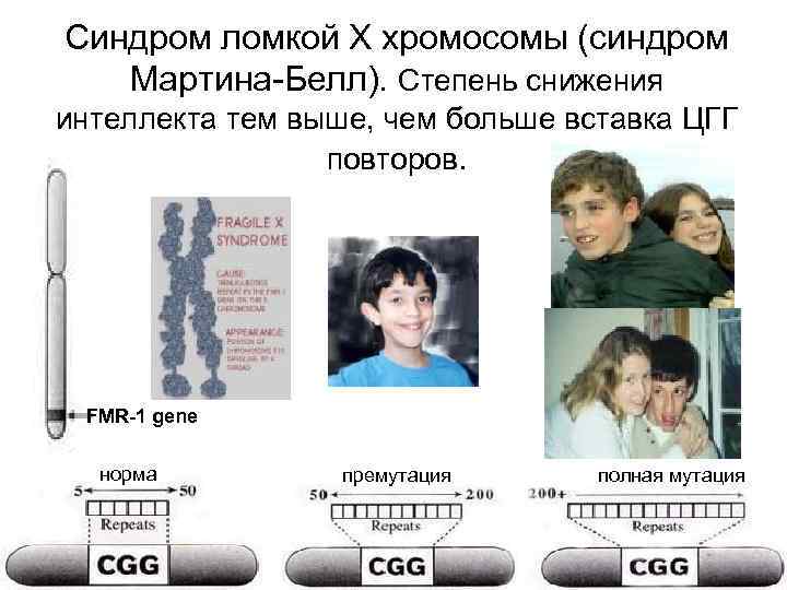 Синдром ломкой Х хромосомы (синдром  Мартина-Белл). Степень снижения интеллекта тем выше, чем больше