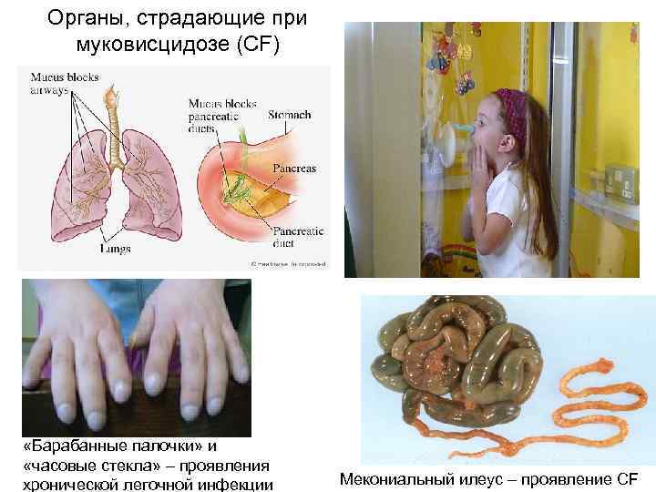  Органы, страдающие при муковисцидозе (СF) «Барабанные палочки» и «часовые стекла» – проявления хронической