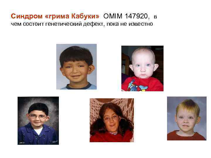 Синдром «грима Кабуки» OMIM 147920, в чем состоит генетический дефект, пока не известно 