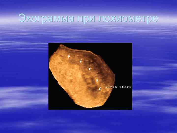 Эхограмма при лохиометре 