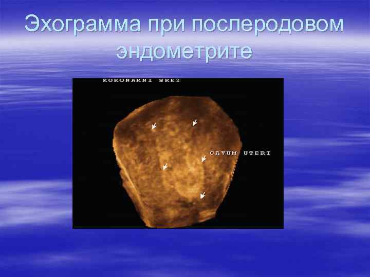 Эхограмма при послеродовом  эндометрите 