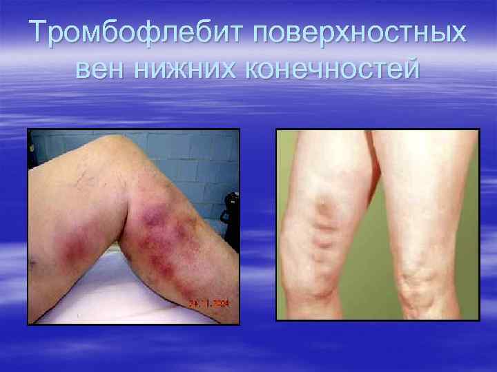 Тромбофлебит поверхностных  вен нижних конечностей 