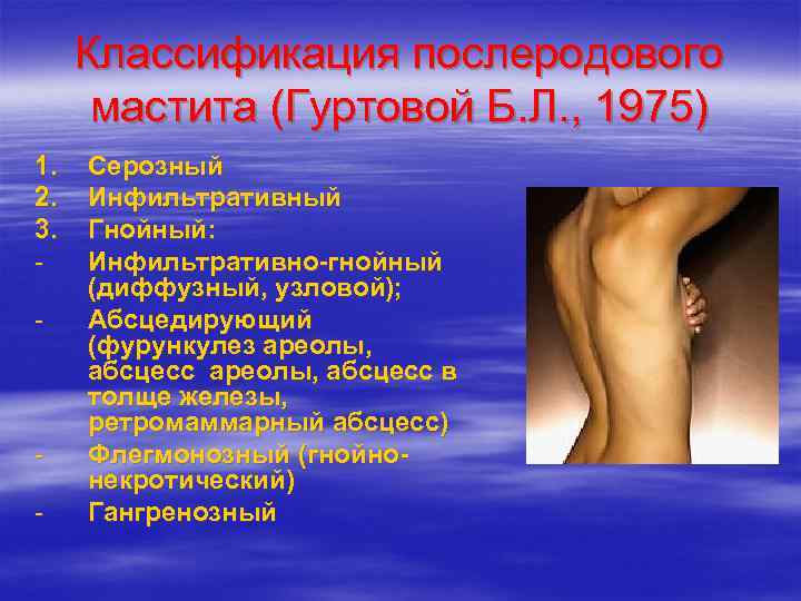  Классификация послеродового  мастита (Гуртовой Б. Л. , 1975) 1.  Серозный 2.