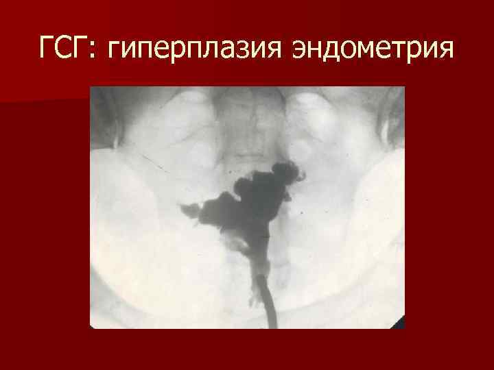 ГСГ: гиперплазия эндометрия 