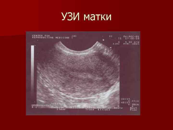 УЗИ матки 