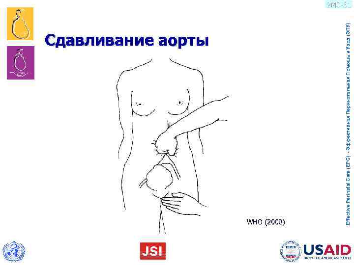       Сдавливание аорты WHO (2000)    