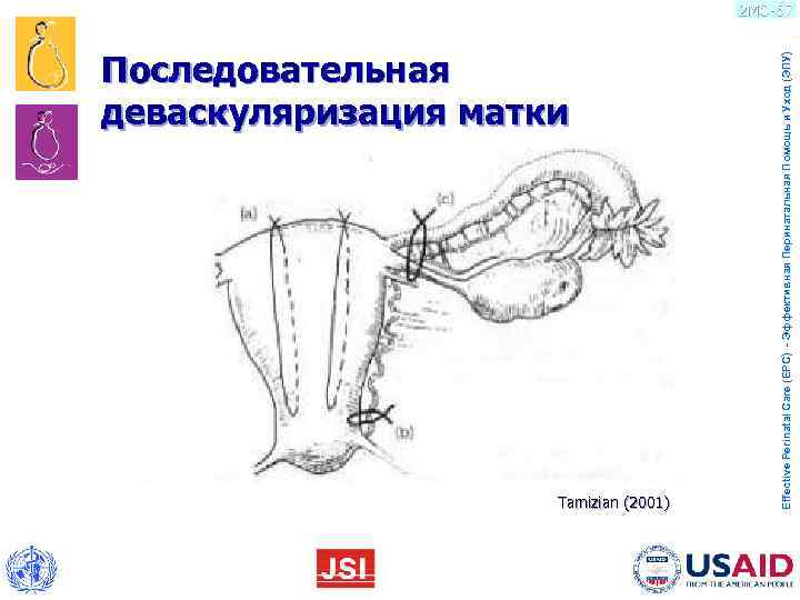       Последовательная      деваскуляризация матки