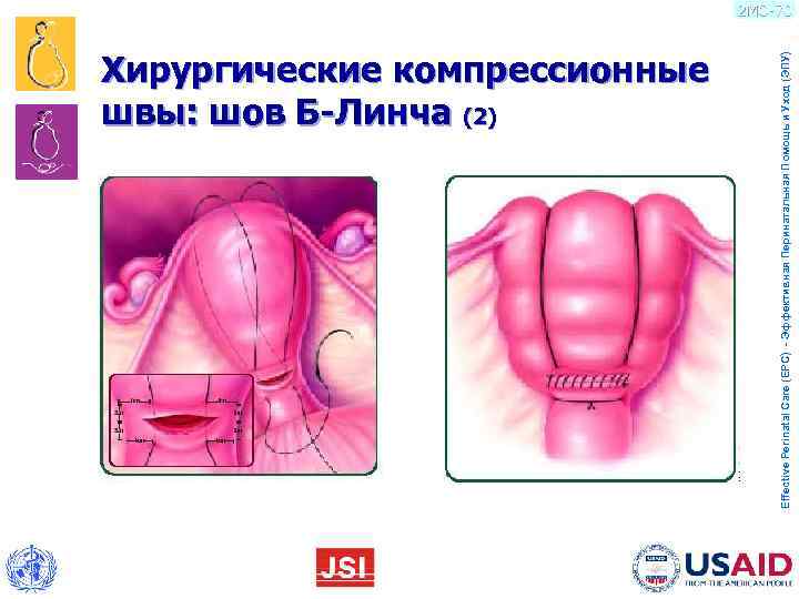       швы: шов Б-Линча (2)    