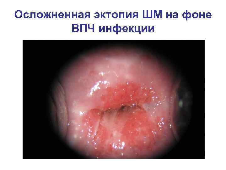 Осложненная эктопия ШМ на фоне   ВПЧ инфекции 