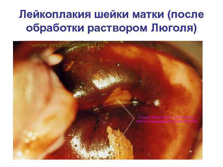 Лейкоплакия шейки матки (после  обработки раствором Люголя) 