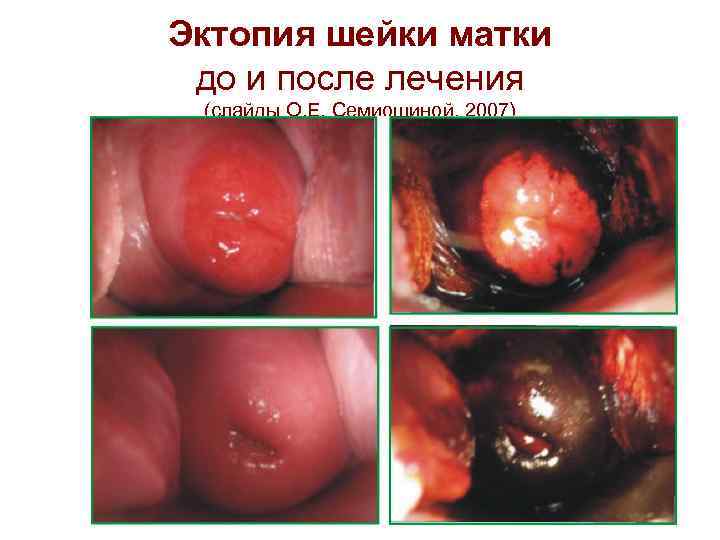 Эктопия шейки матки  до и после лечения  (слайды О. Е. Семиошиной, 2007)