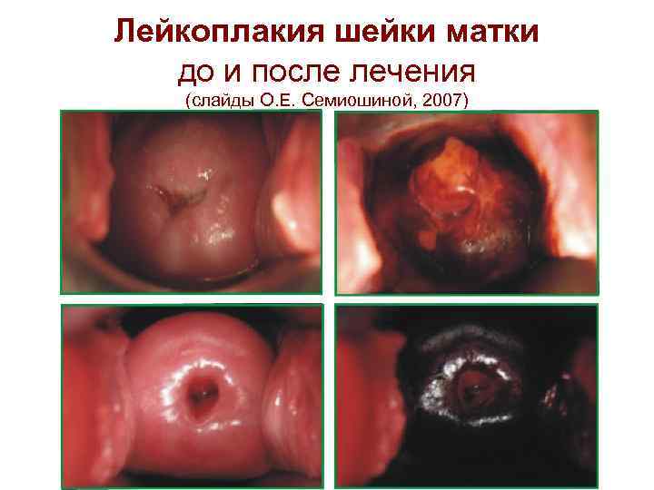 Лейкоплакия шейки матки до и после лечения (слайды О. Е. Семиошиной, 2007) 