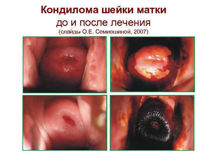 Кондилома шейки матки до и после лечения (слайды О. Е. Семиошиной, 2007) 