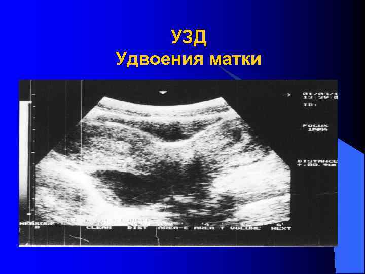  УЗД Удвоения матки 