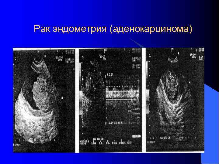 Рак эндометрия (аденокарцинома) 