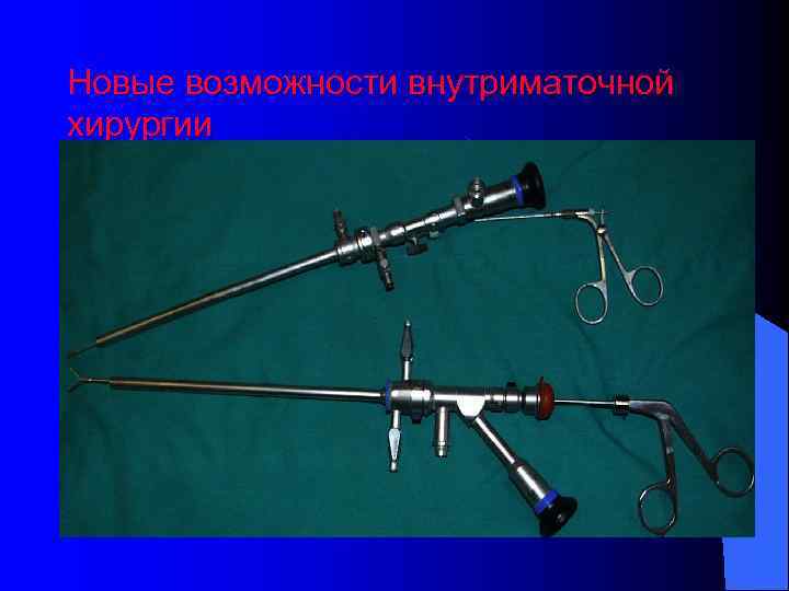 Новые возможности внутриматочной хирургии 