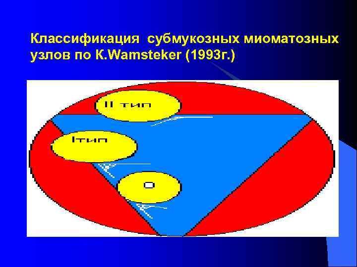 Классификация субмукозных миоматозных узлов по К. Wamsteker (1993 г. ) 