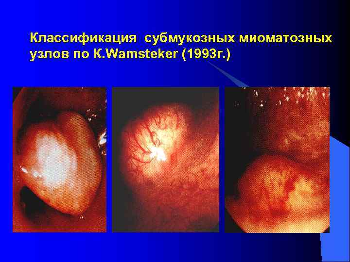 Классификация субмукозных миоматозных узлов по К. Wamsteker (1993 г. ) 