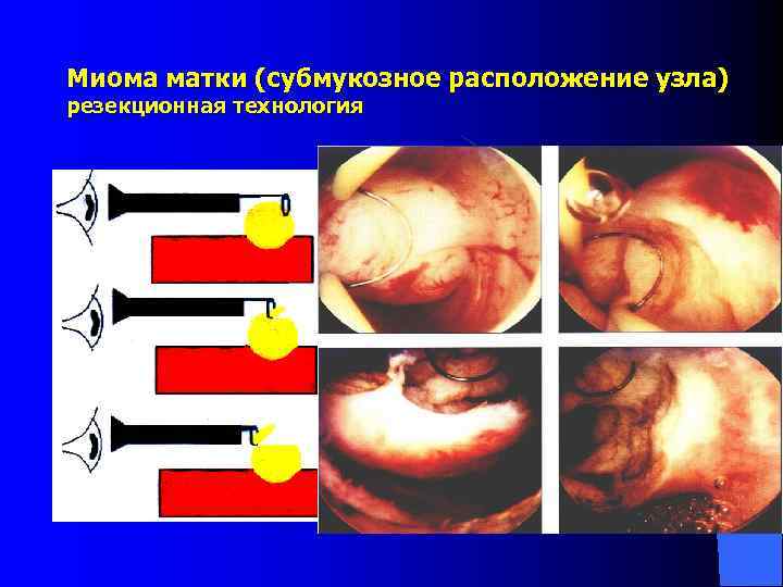 Миома матки (субмукозное расположение узла) резекционная технология 