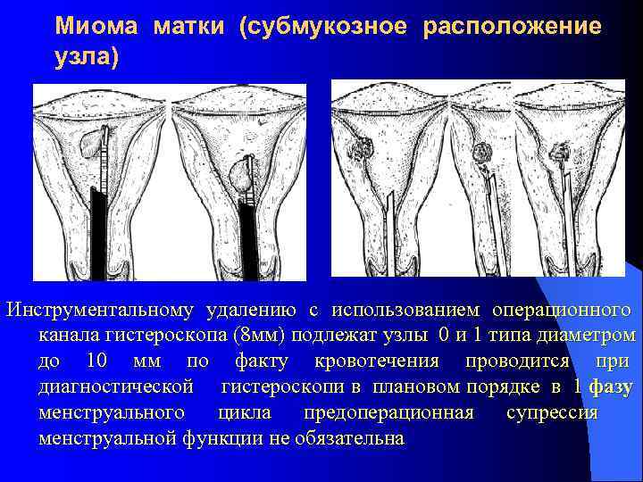   Миома матки (субмукозное расположение узла) Инструментальному удалению с использованием операционного  канала