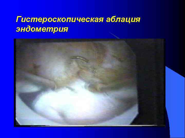 Гистероскопическая аблация эндометрия 