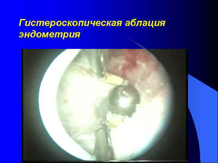 Гистероскопическая аблация эндометрия 