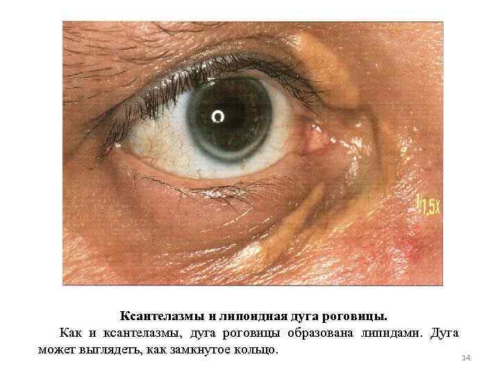    Ксантелазмы и липоидная дуга роговицы.  Как и ксантелазмы,  дуга