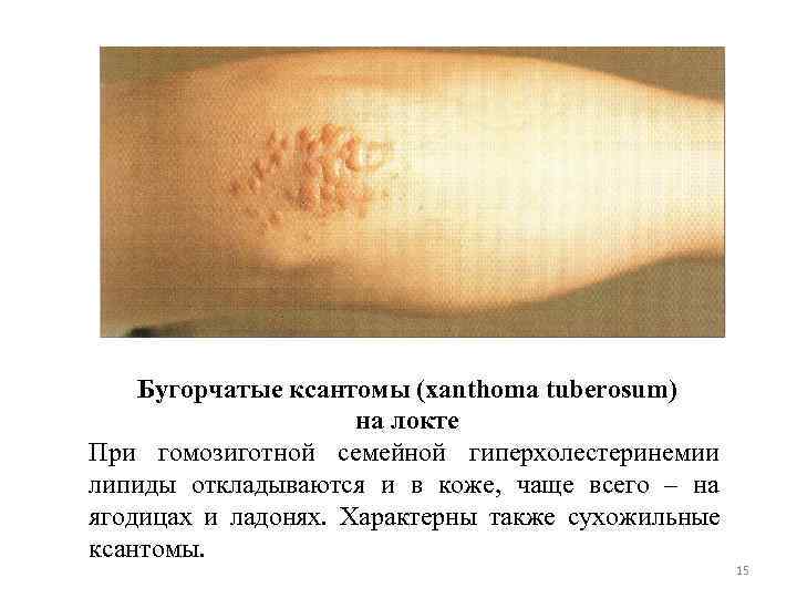   Бугорчатые ксантомы (xanthoma tuberosum)     на локте При гомозиготной