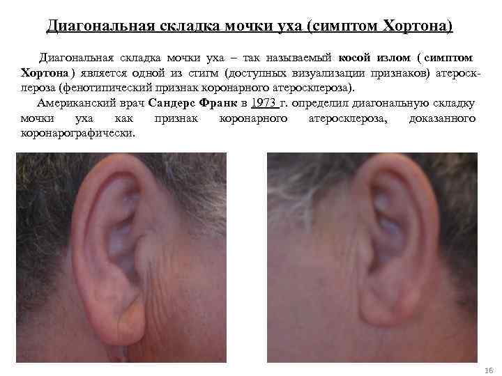   Диагональная складка мочки уха (симптом Хортона)  Диагональная складка мочки уха –