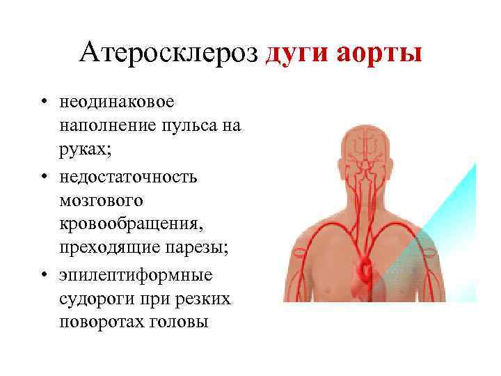   Атеросклероз дуги аорты • неодинаковое  наполнение пульса на  руках; 