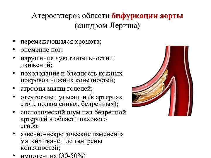 Атеросклероз области бифуркации аорты   (синдром Лериша) • перемежающаяся хромота;  •