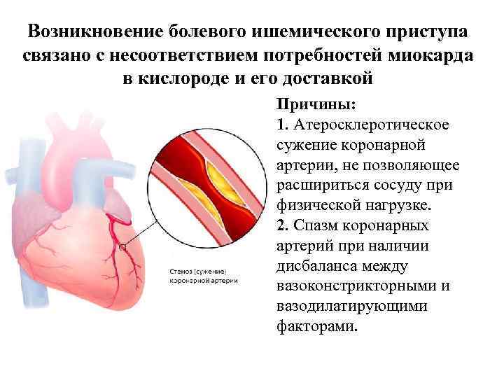  Возникновение болевого ишемического приступа связано с несоответствием потребностей миокарда   в кислороде