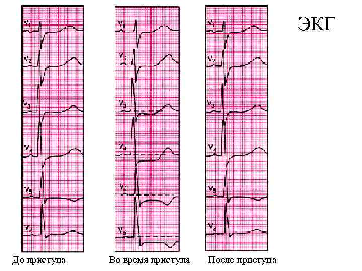        ЭКГ До приступа   Во время