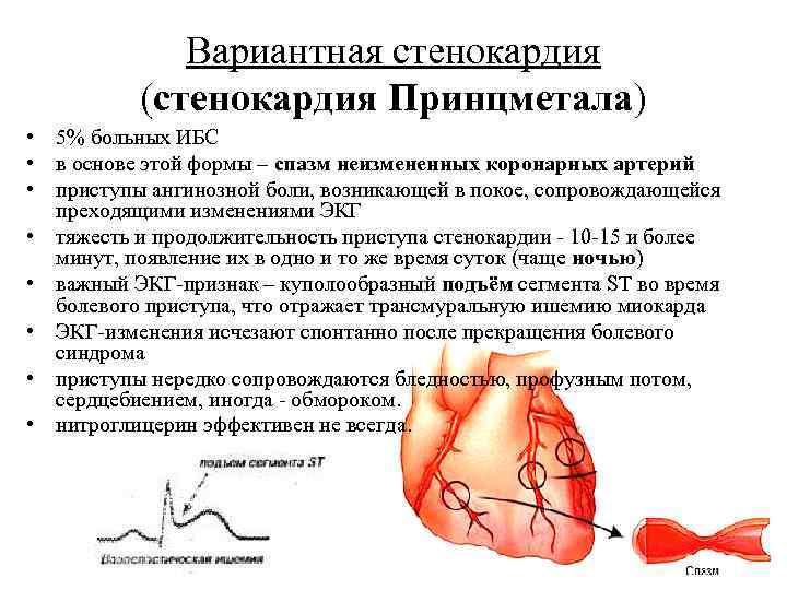    Вариантная стенокардия  (стенокардия Принцметала) • 5% больных ИБС • в