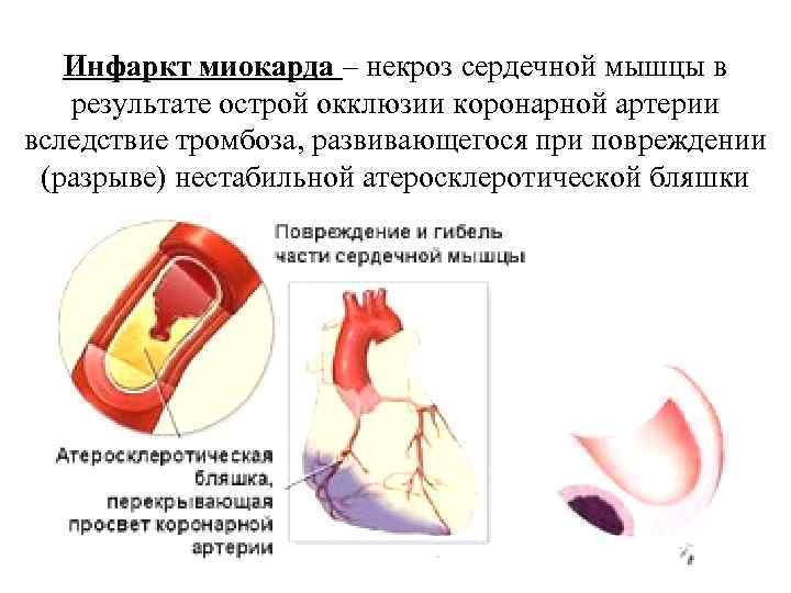   Инфаркт миокарда – некроз сердечной мышцы в результате острой окклюзии коронарной артерии
