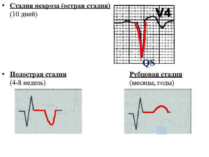  • Стадия некроза (острая стадия)  (10 дней)    QS •