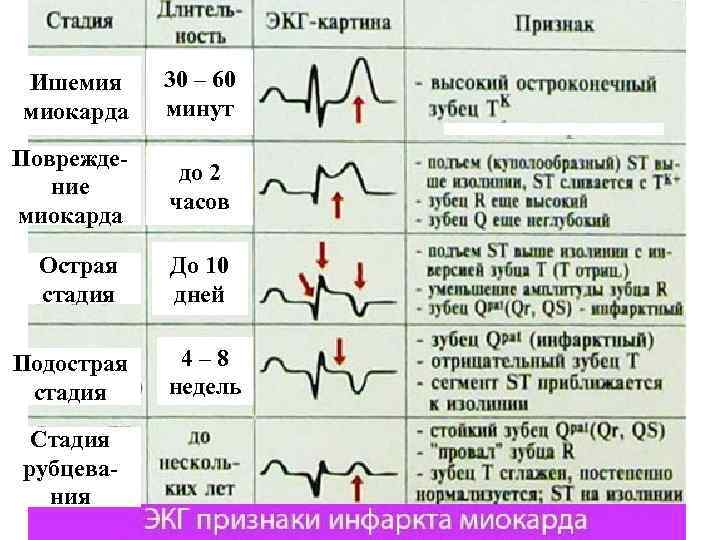Ишемия  30 – 60 миокарда минут Поврежде-    до 2 ние