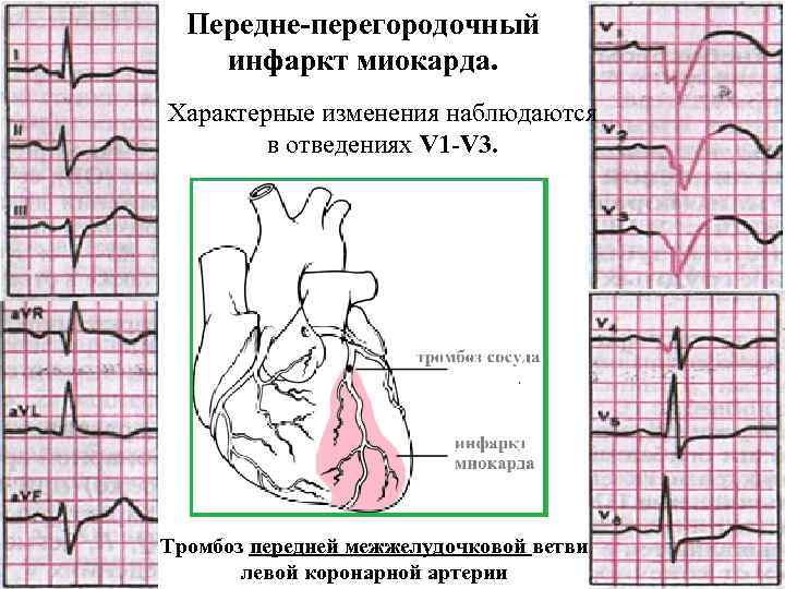  Передне-перегородочный инфаркт миокарда. Характерные изменения наблюдаются   в отведениях V 1 -V